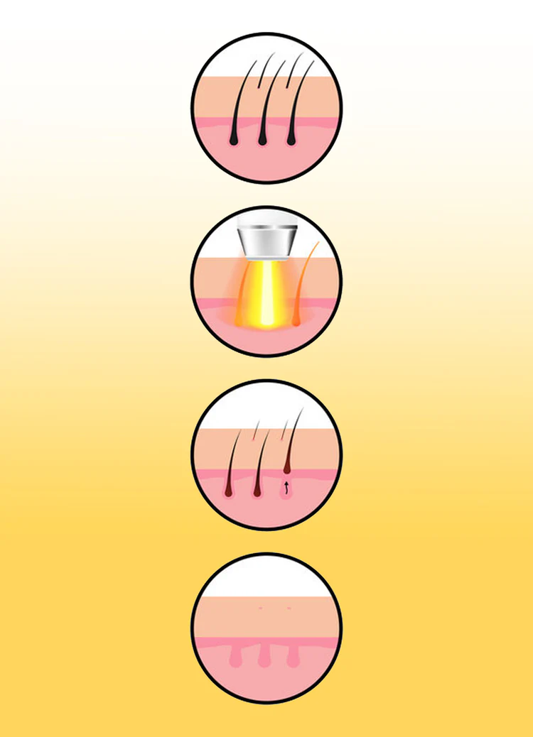 Laser Hair Removal